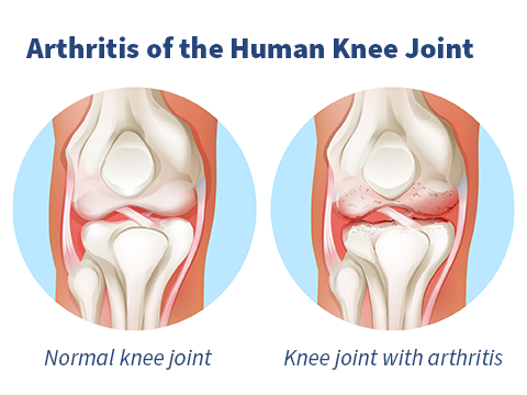 Knee illustration with and without arthritis