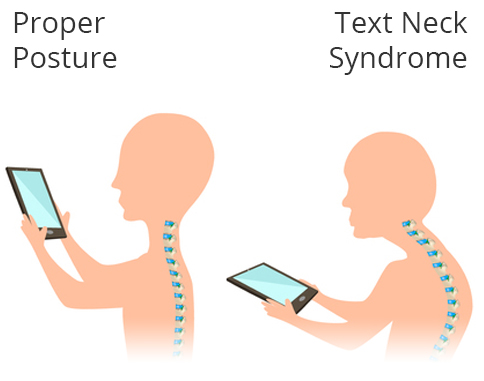 Tech neck syndrome graphic