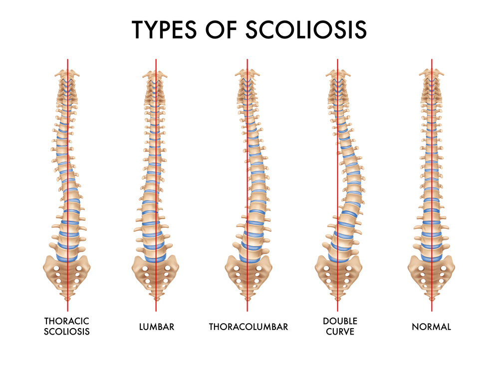 a diagram comparing the spinal curves of different types of scoliosis