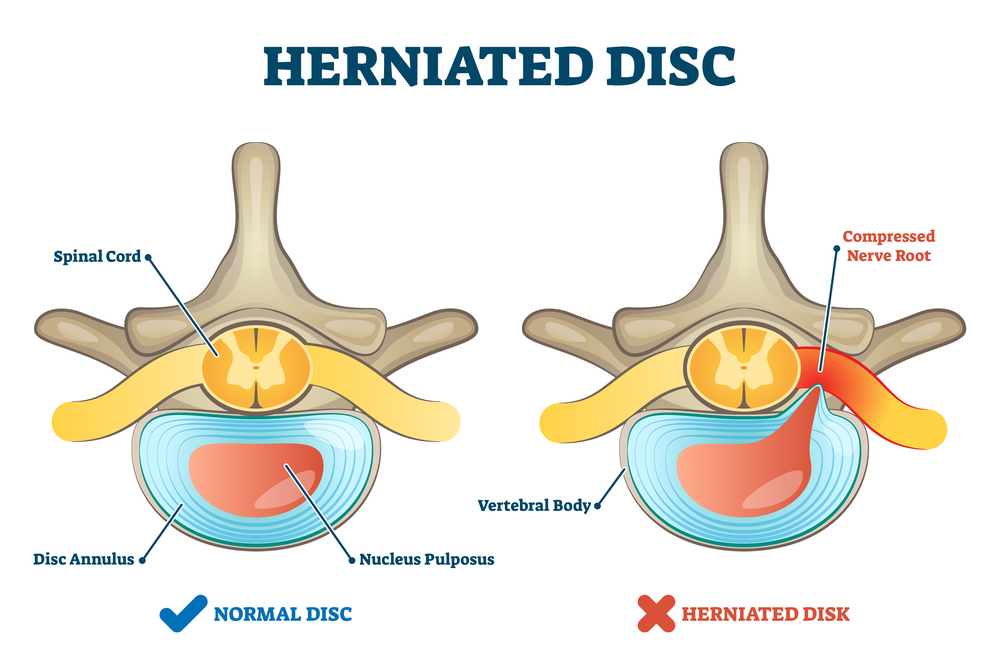 A medical diagram shows a herniated disc compared to a normal disc.
