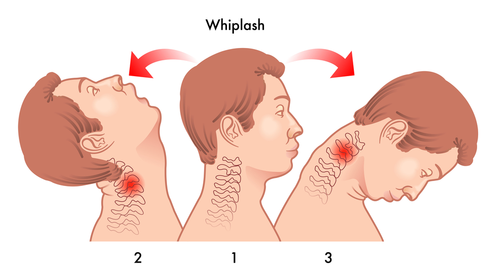 A vector image describes how whiplash occurs.