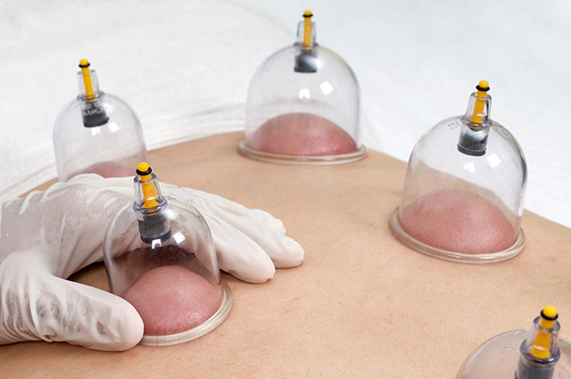 Cupping Therapy Single Session
